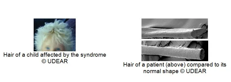 Uncombable Hair Syndrome: Clinical and Microscopic View