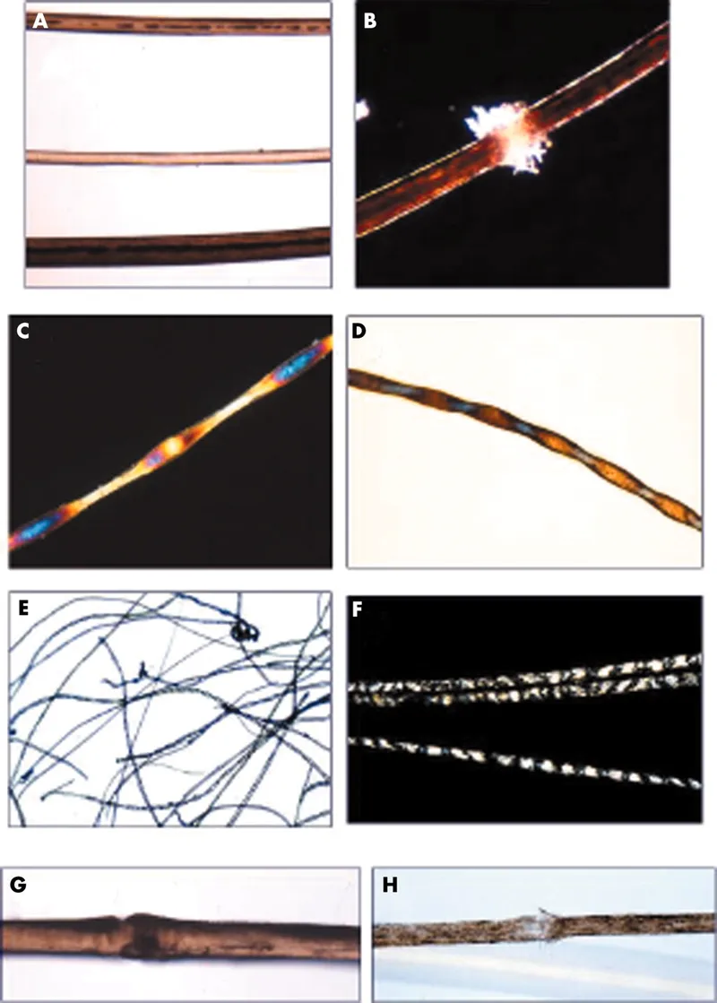 Microscopy of hair shaft abnormalities