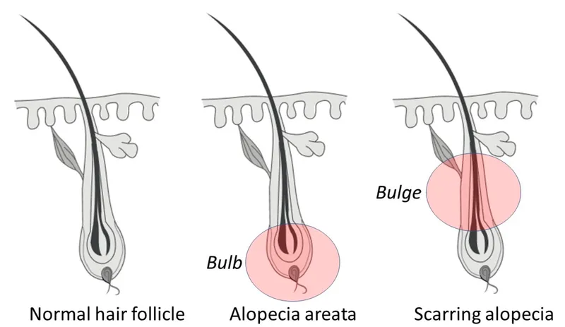 Hair follicle in normal, alopecia areata, scarring alopecia