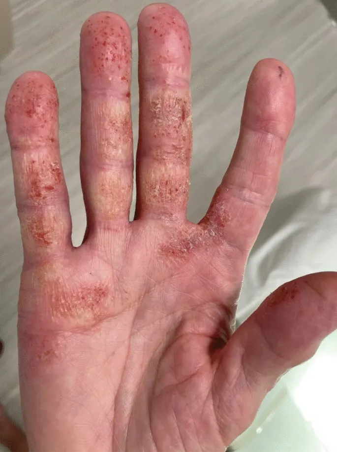 Allergic contact dermatitis on hand