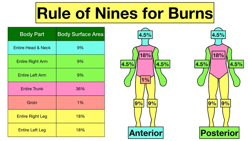 Rule of Nines for TBSA Estimation