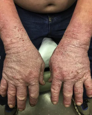Chronic irritant contact dermatitis on hands