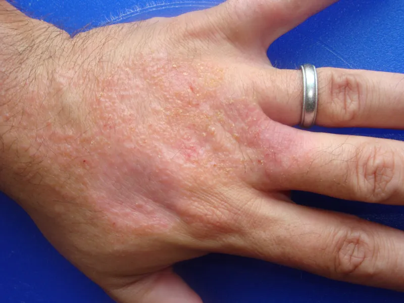 Irritant contact dermatitis on hand