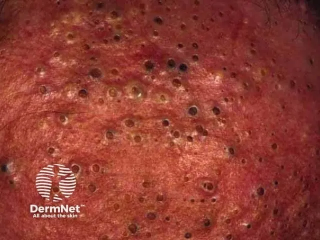 Occupational Chloracne Lesions