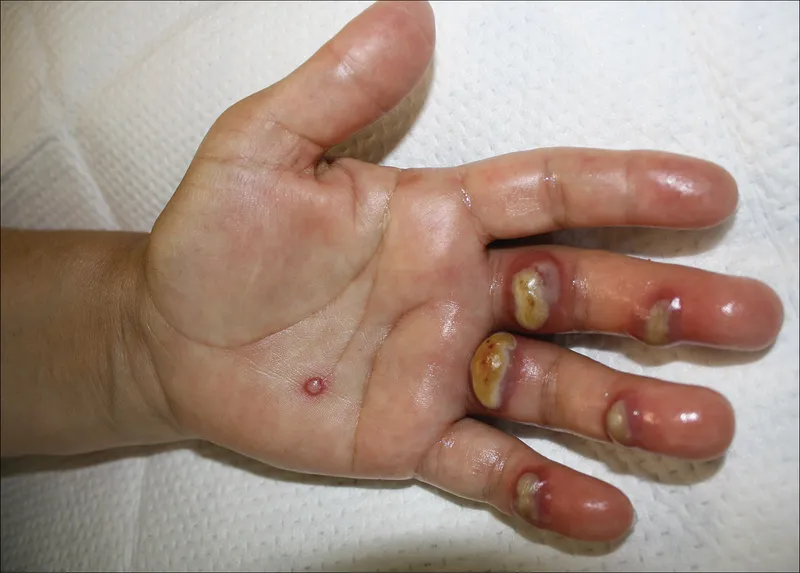 Orf lesions on fingers and palm