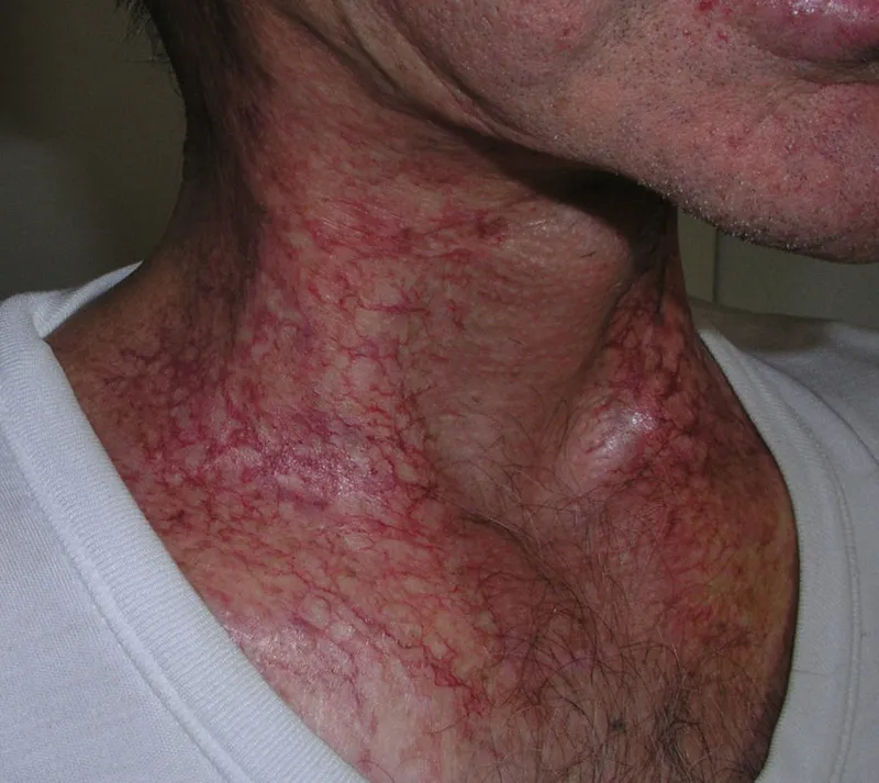 Chronic radiodermatitis with telangiectasia