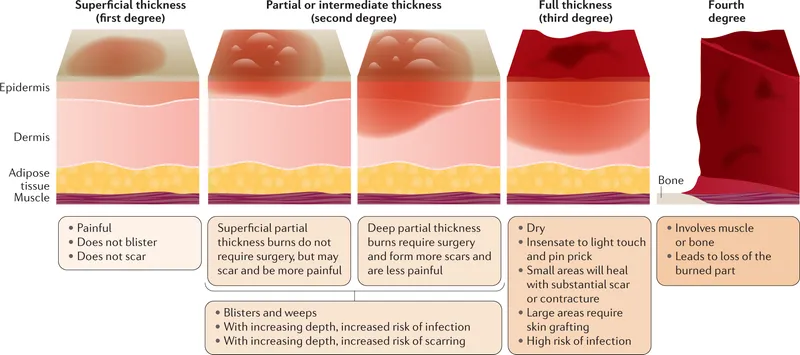 Burn Depth Classification by Skin Layer