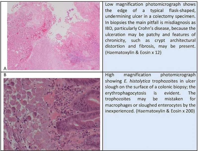 E. histolytica trophozoites in colonic ulcer slough
