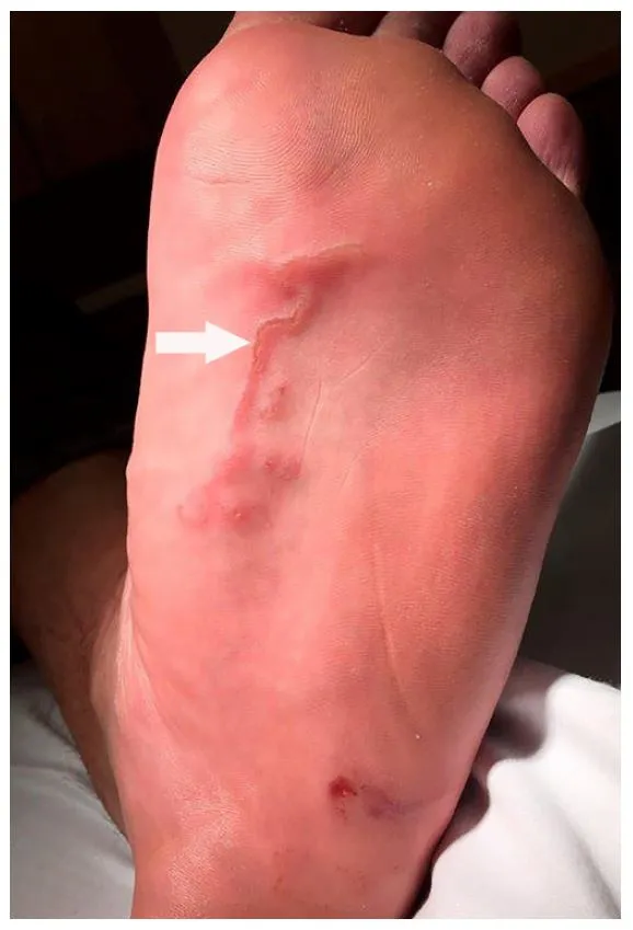 Cutaneous Larva Migrans lesion on foot