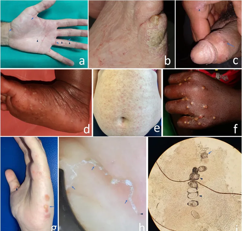 Scabies manifestations and mite microscopy