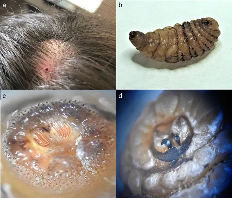 Dermatobia hominis larva in skin lesion and close-ups