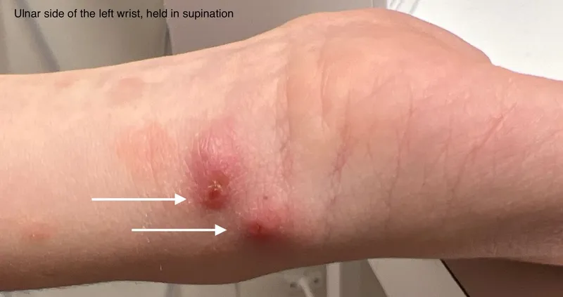 Furuncular Myiasis Lesions on Wrist