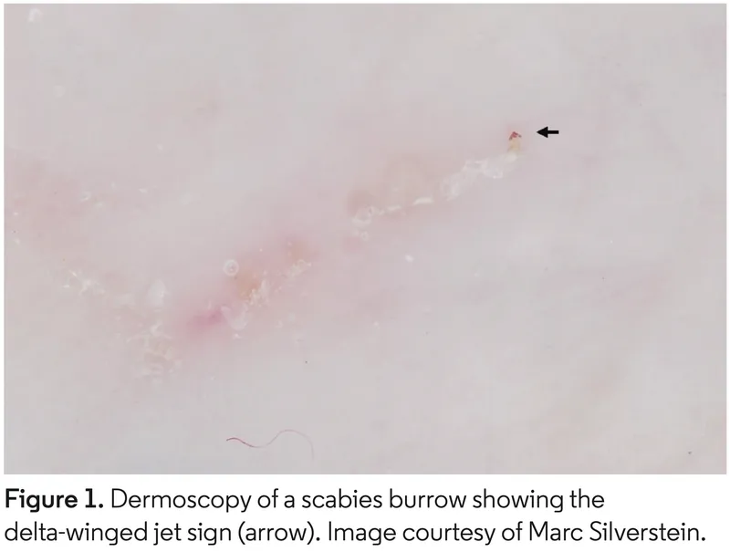 Scabies burrow with delta-winged jet sign