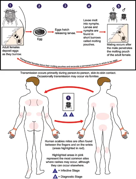 Scabies mite life cycle and skin burrow