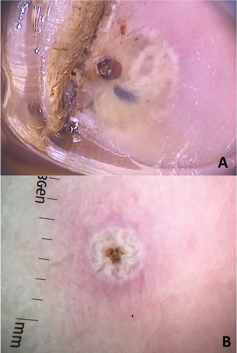 Tungiasis dermoscopy showing flea posterior and eggs