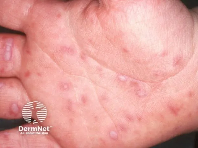 Vesicular lesions on palm in Hand Foot Mouth Disease