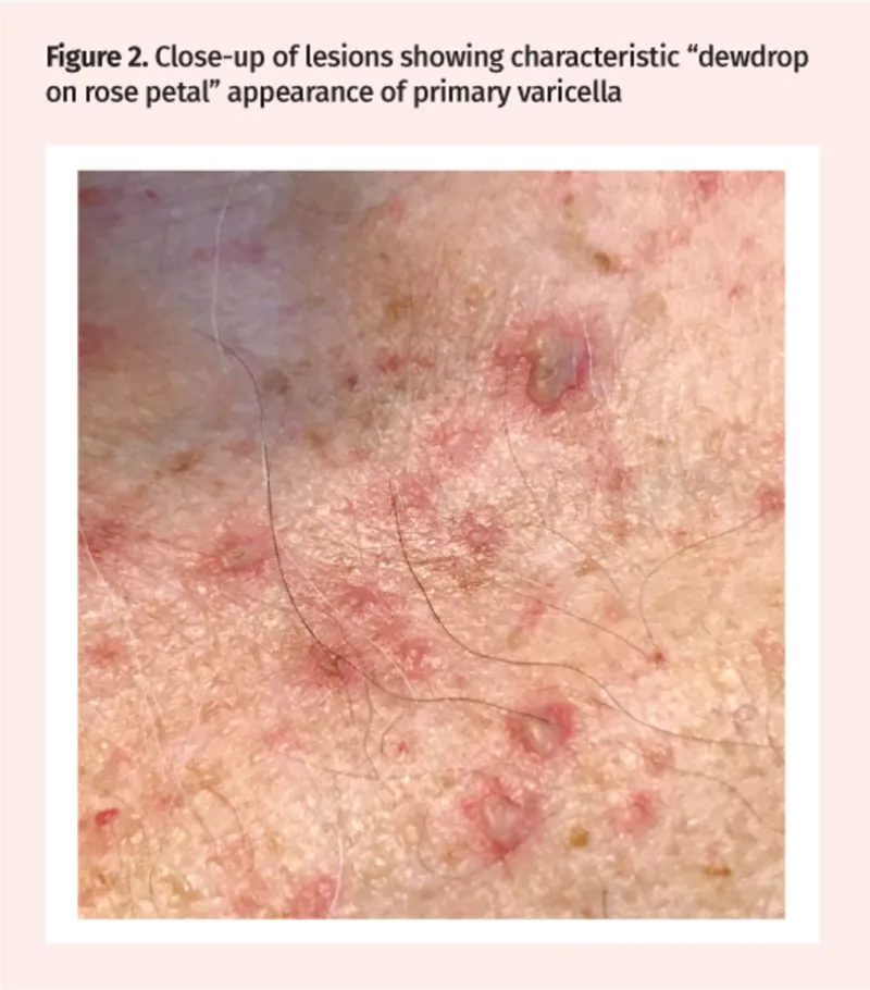 Varicella "dewdrop on rose petal" lesions