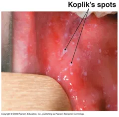 Koplik's spots on buccal mucosa