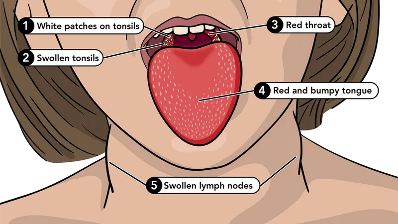 Scarlet Fever Symptoms
