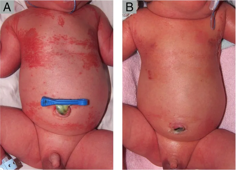 Neonatal candidiasis before and after treatment