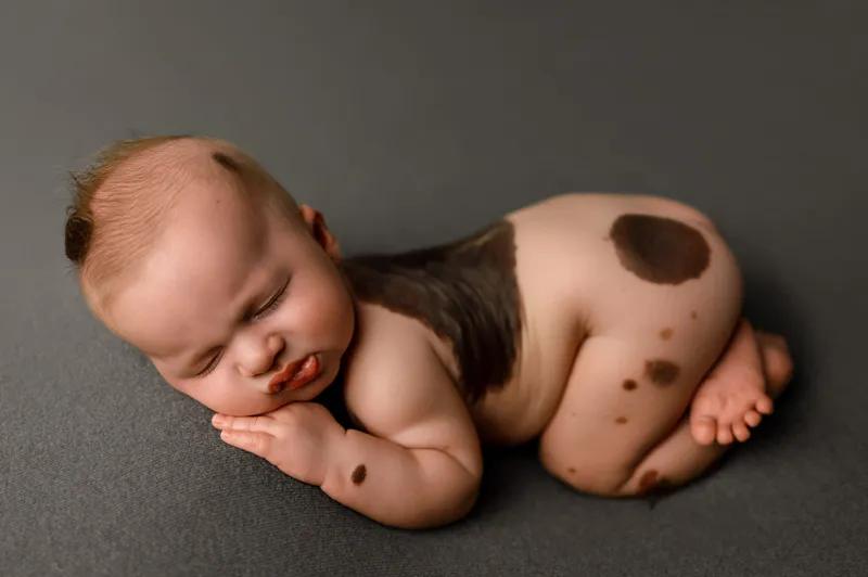 Giant congenital melanocytic nevus on infant's back