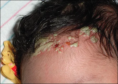 Neonatal Staphylococcal Pustulosis on Scalp
