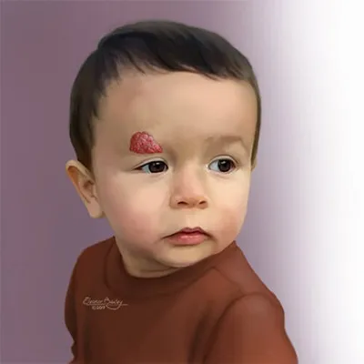 Superficial infantile hemangioma on infant's forehead