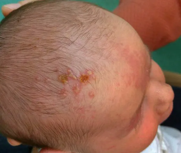 Neonatal Herpes Simplex vesicles on scalp