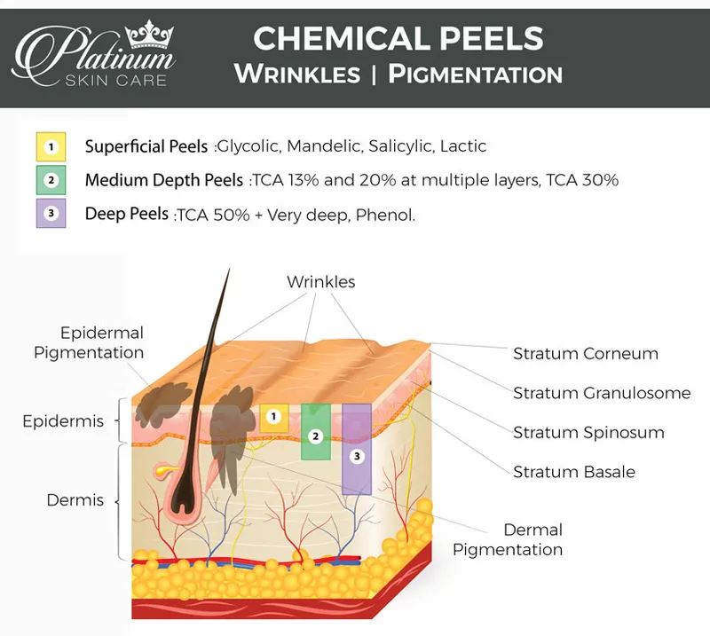Chemical Peel Depths and Skin Layers