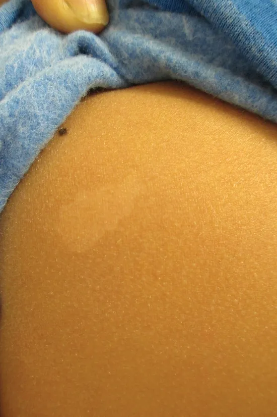 Hypopigmented patch on skin