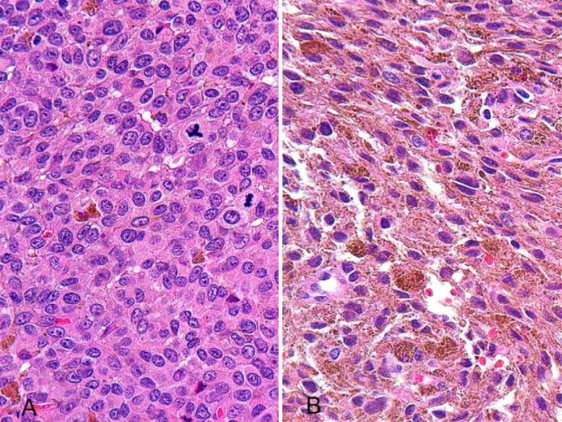 Histopathology of Nevus of Ota