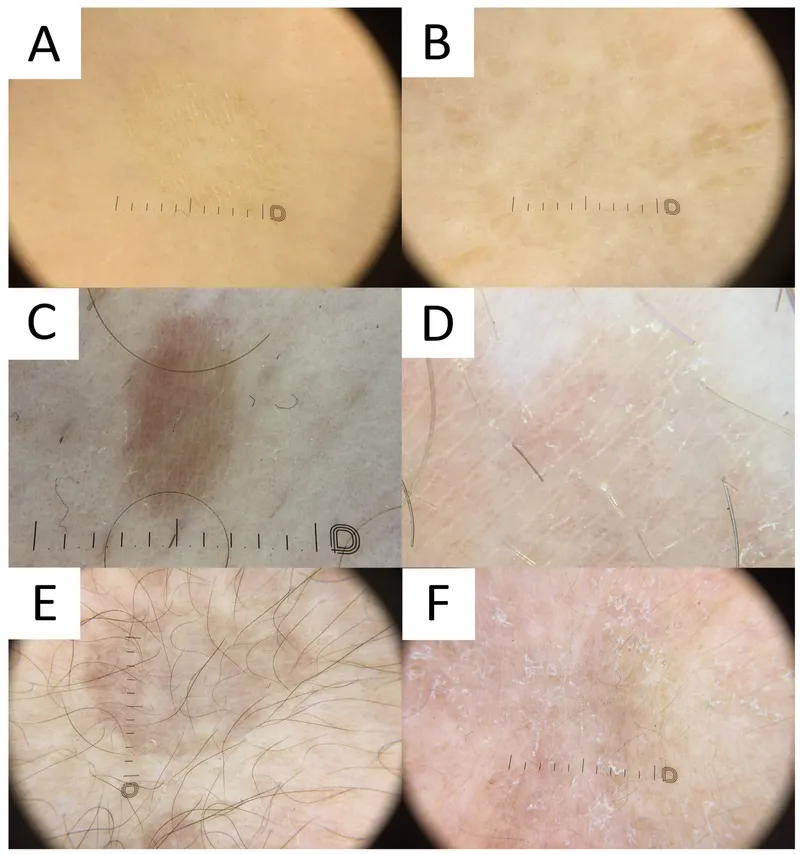 Dermoscopy of Pityriasis Alba vs Tinea Versicolor