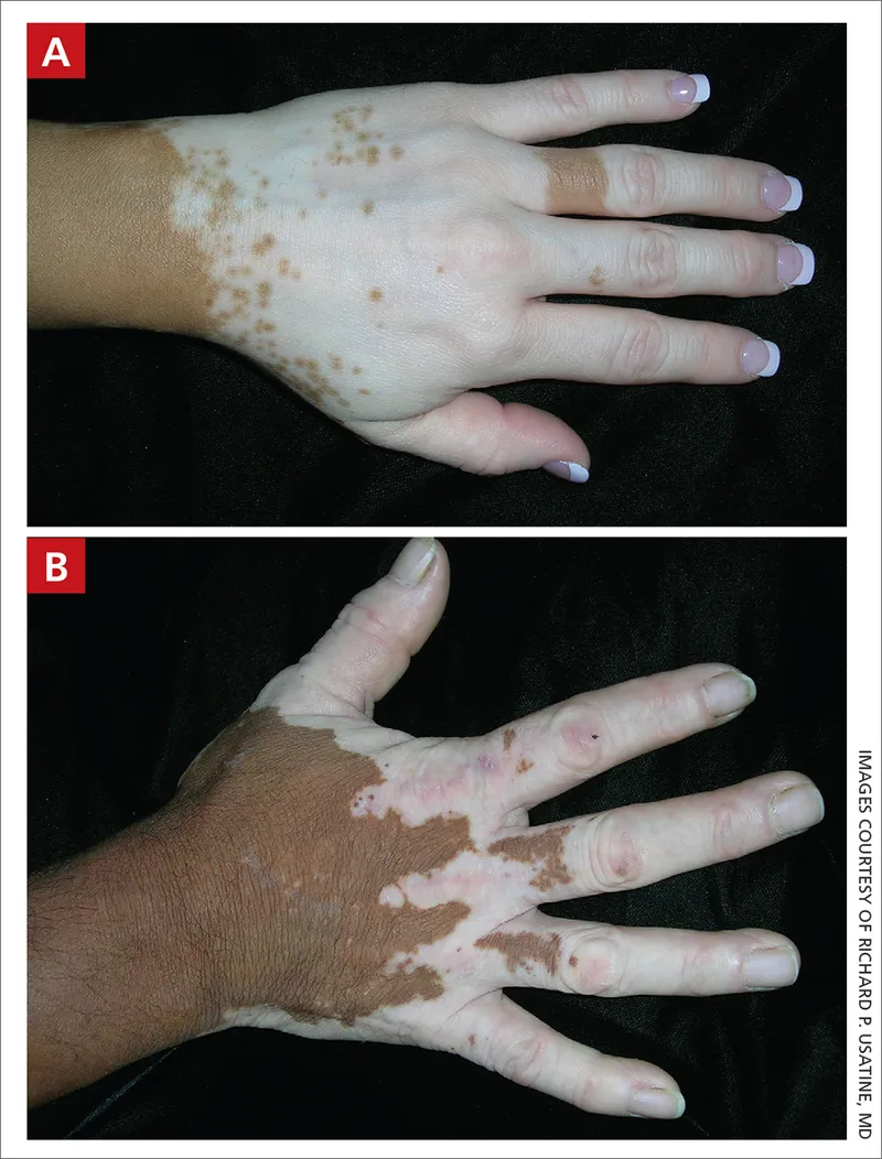 Vitiligo on hands
