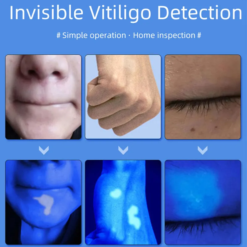 Vitiligo under Wood's lamp