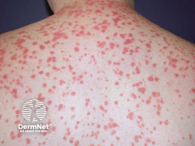 Guttate Psoriasis: Raindrop Lesions on Back
