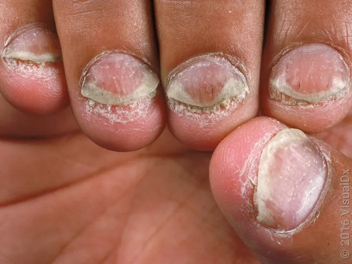 Nail Psoriasis with Pitting and Onycholysis
