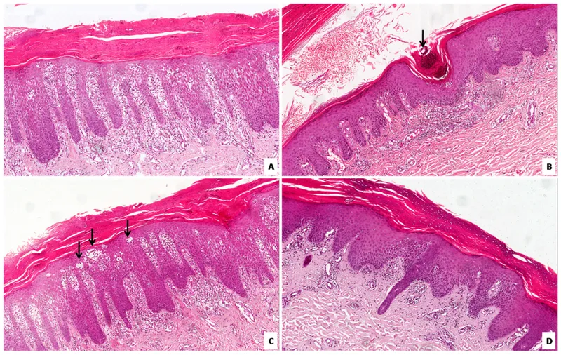 Histopathology of palmoplantar psoriasis