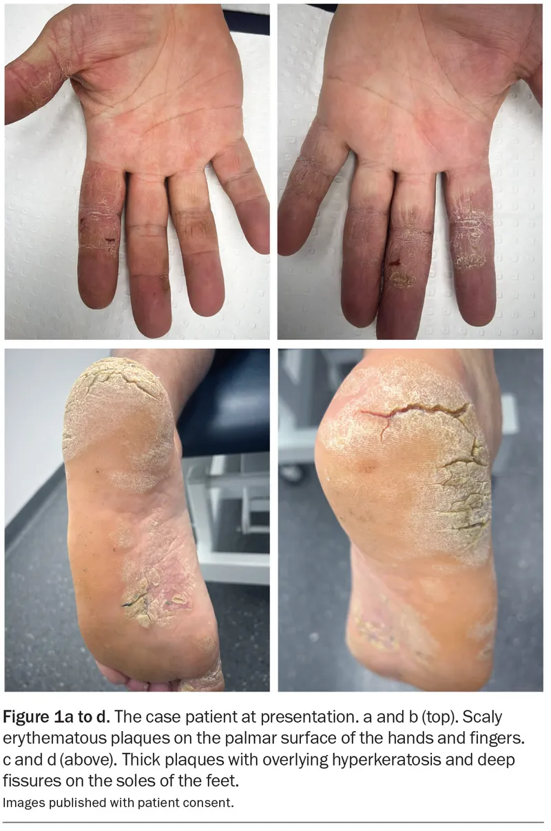 Palmoplantar Psoriasis: Hands and Feet