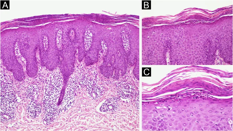 Histopathology of psoriasis