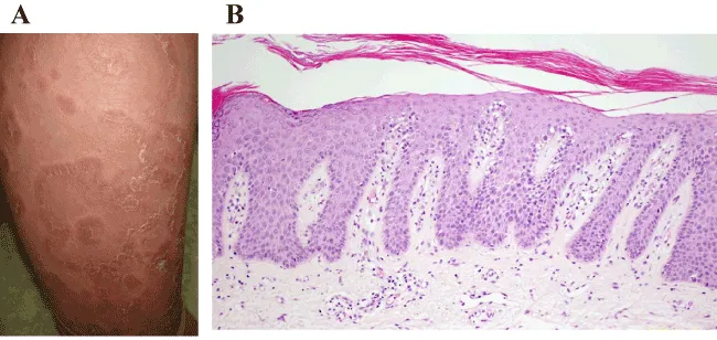 Kogoj's Spongiform Pustule in Pustular Psoriasis