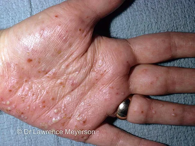 Sterile pustules on palm in Palmoplantar Pustulosis