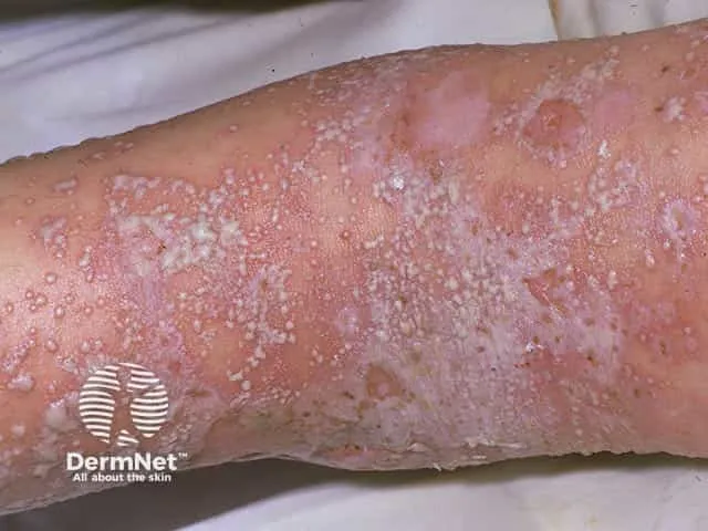 Generalized pustular psoriasis with lakes of pus