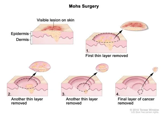 Mohs surgery steps