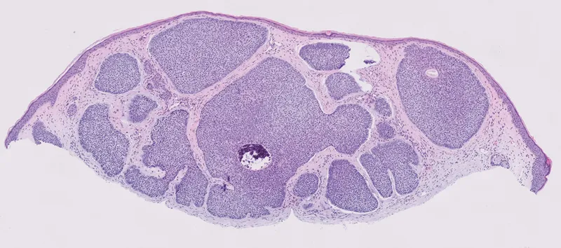 Basal Cell Carcinoma Histopathology