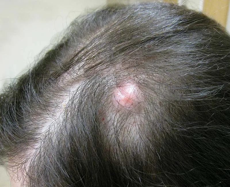 Pilar cyst on scalp