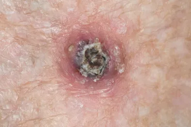 Keratoacanthoma with central keratin plug