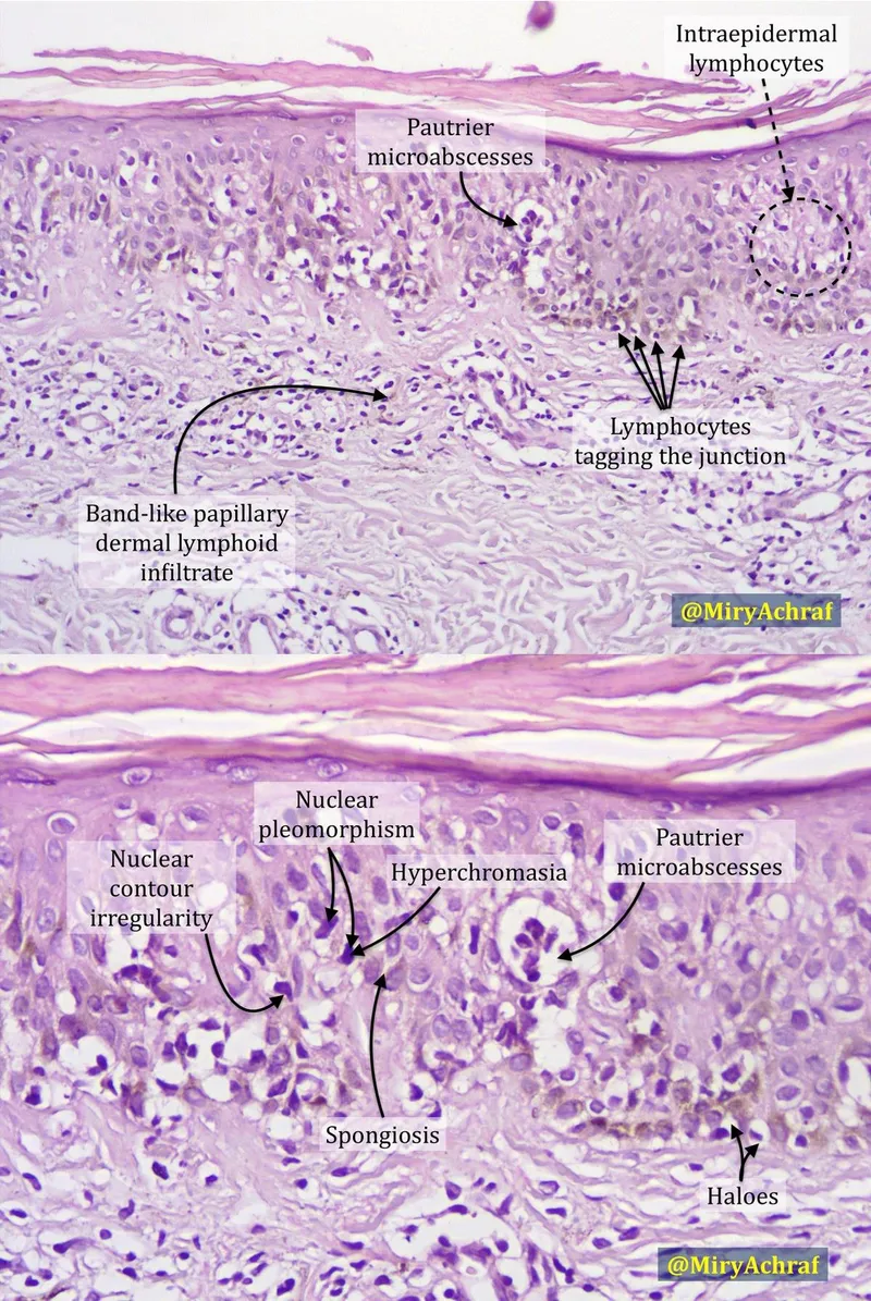 Mycosis Fungoides Histology: Pautrier's Microabscess
