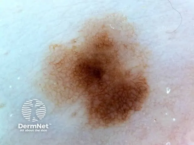 Dermoscopic view of dysplastic nevus