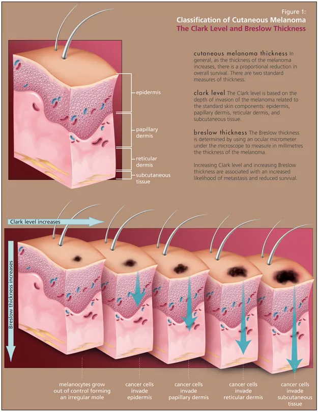 Melanoma Staging: Clark Level & Breslow Thickness