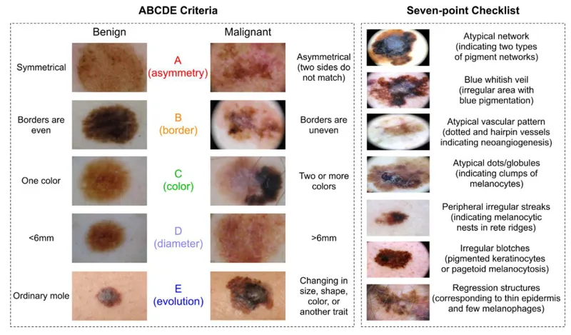 Melanoma ABCDE & 7-point checklist